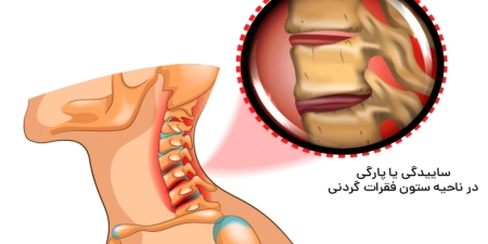 اطلاعات بیشتر درباره ی بهترین دکتر جراحی آرتروز گردن در تهران