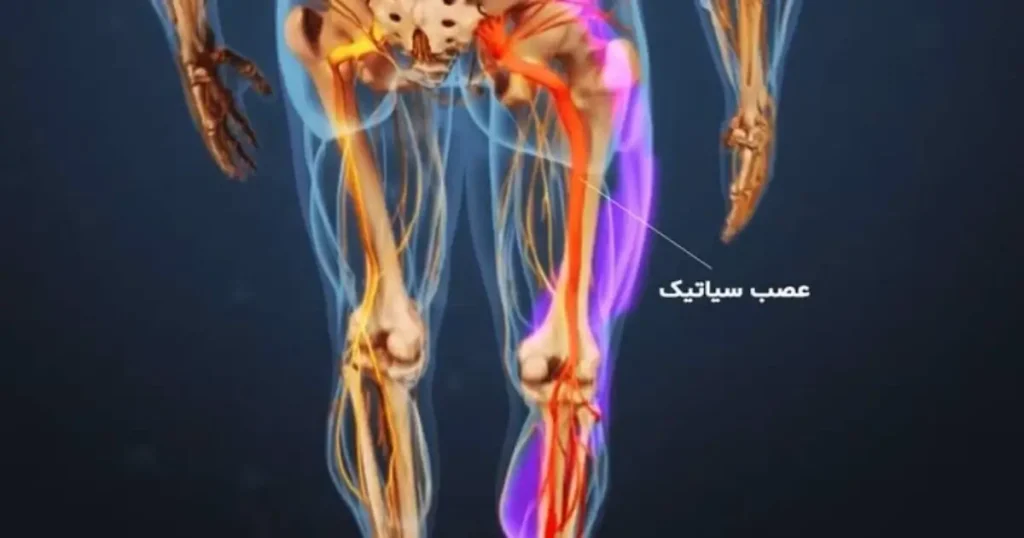 بهترین دکتر متخصص و فوق تخصص سیاتیک (معرفی 16 نفر)