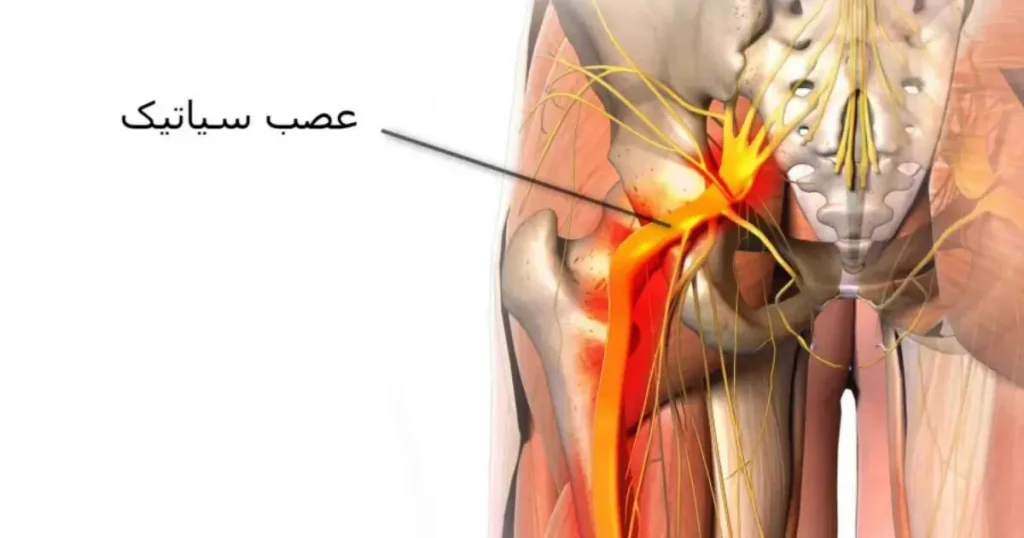 اطلاعات بیشتر درباره ی دکتر رگ سیاتیک در ایران