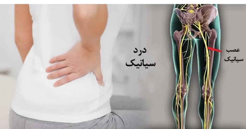 بهترین دکتر سیاتیک در تهران کیست (معرفی 10 پزشک)