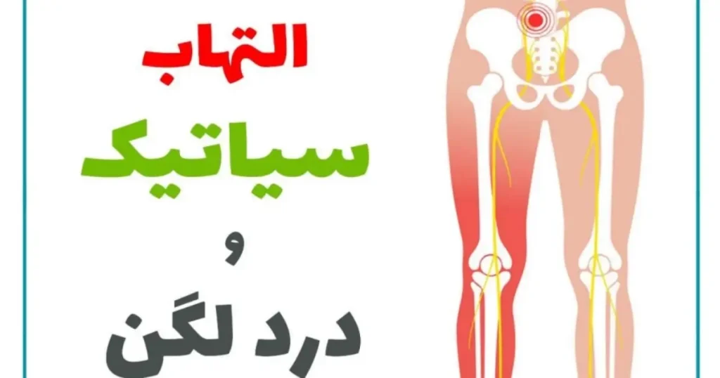 تأثیر فعالیت بدنی بر سیاتیک