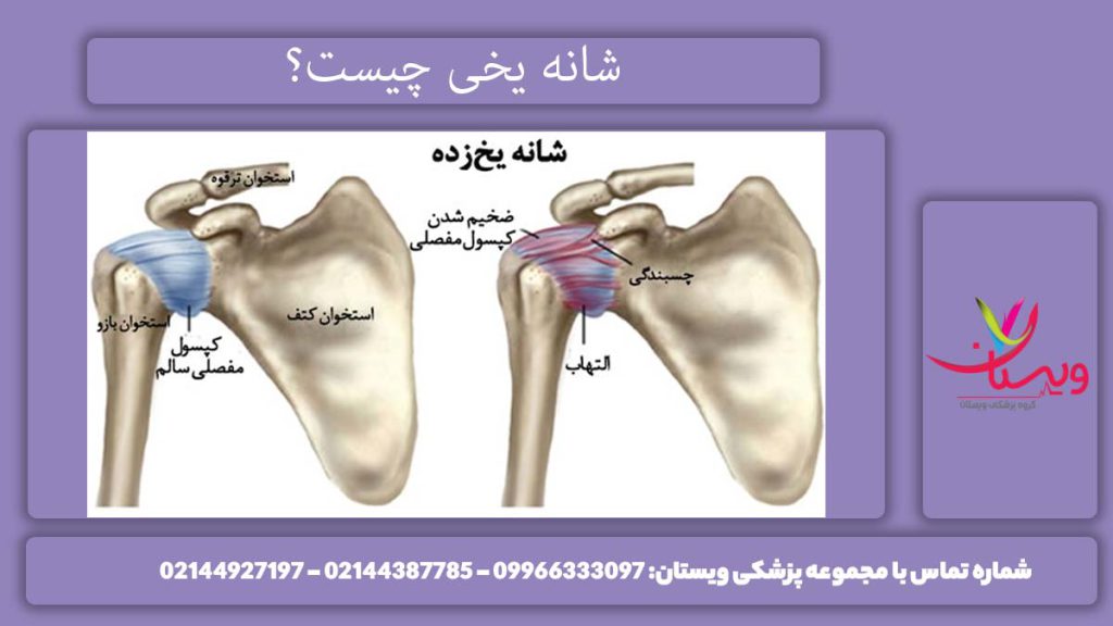 بررسی کامل بیماری شانه منجمد