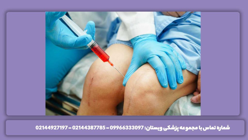 اثر گذاری تزریق پی ار پی مدت زمان ماندگاری پی آر پی زانو