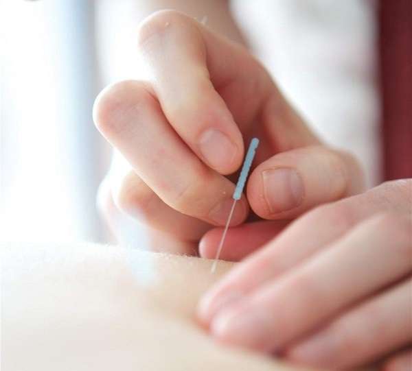 انجام طب سوزنی بر روی پوست