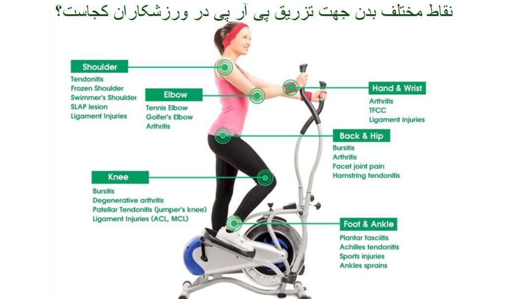 نقاط تزریق پی آر پی برای ورزشکاران بر روی یک زن علاقه مند به ورزش نشان داده شده است. یک خانم در حال ورزش کردن است و نقاط مختلف بدن جهت تزریق پی آرپی در ورزشکاران در بدن او نشان داده شده است.