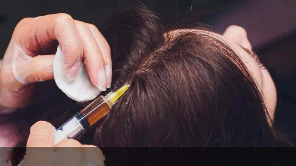 این عکس یک خانم را نشان می دهد که در حال تزریق PRP به پوست کف سر جهت درمان ریزش مو می باشد.