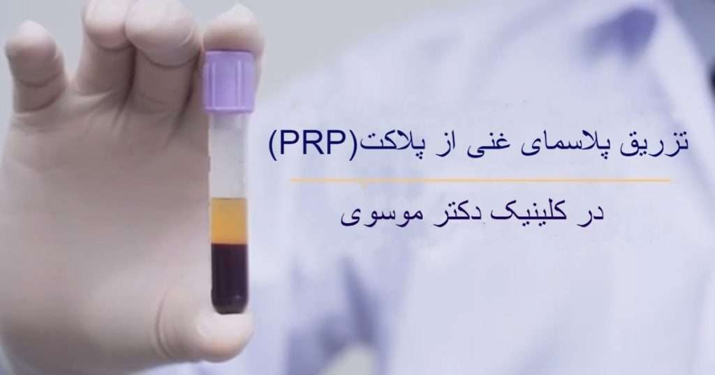 این عکس کاربردهای تزریق پی آر پی در کلینیک دکتر موسوی را نشان می دهد. یک ویال کیت که حاوی خون سانتریفیوژ شده است در دست یک دکتر به نمایش گذاشته شده است.