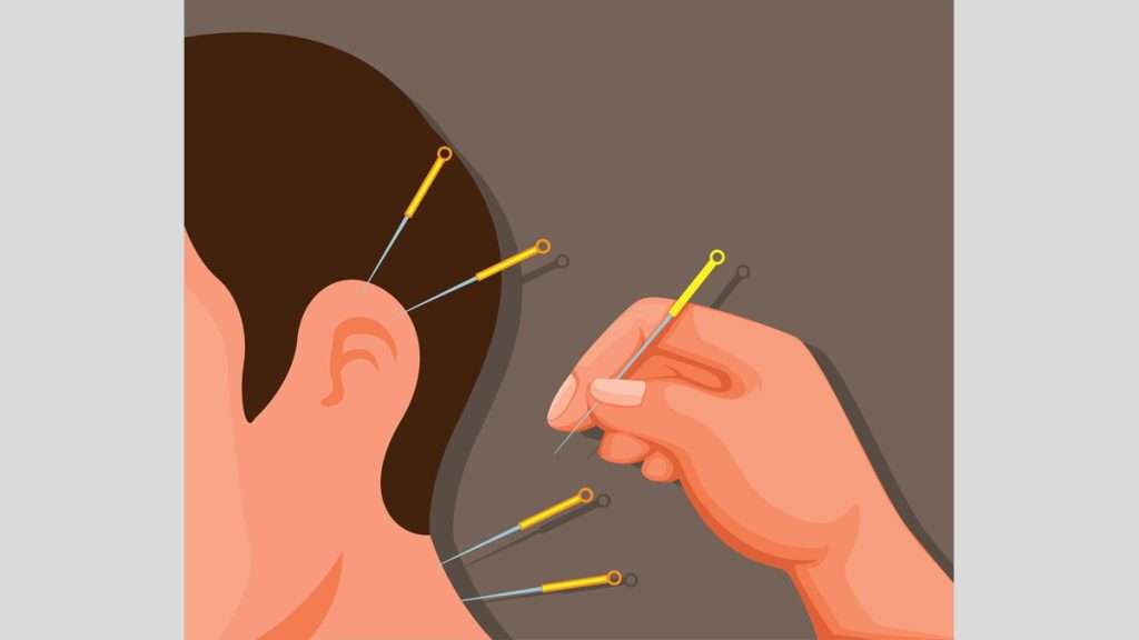 طب سوزنی و وزوز گوش طب سوزنی در درمان وزوز گوش