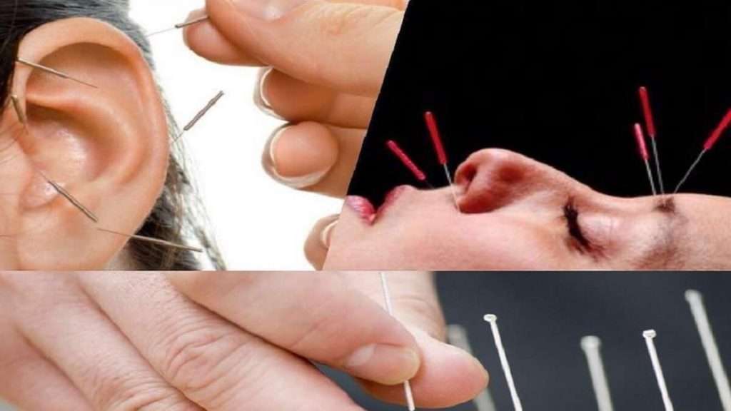 نقاط طب سوزنی در صورت و گوش نقاط طب سوزنی در صورت و گوش