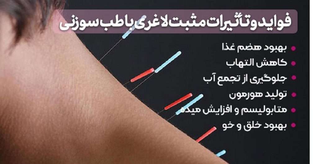 فواید طب سوزنی فواید طب سوزنی