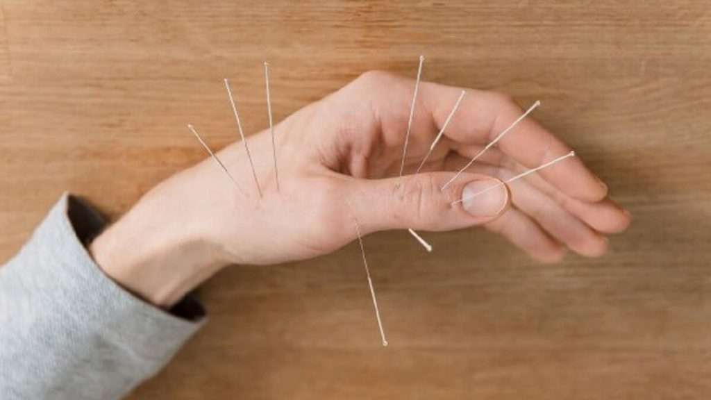 نقاط طب سوزنی دست نقاط طب سوزنی دست