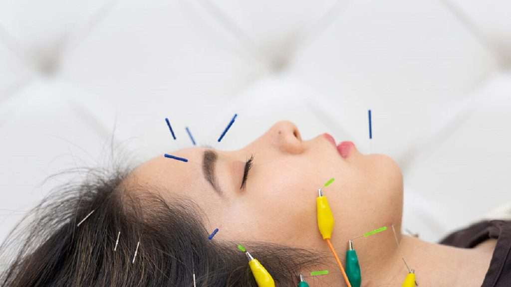 اکوپانچر (Acupuncture)