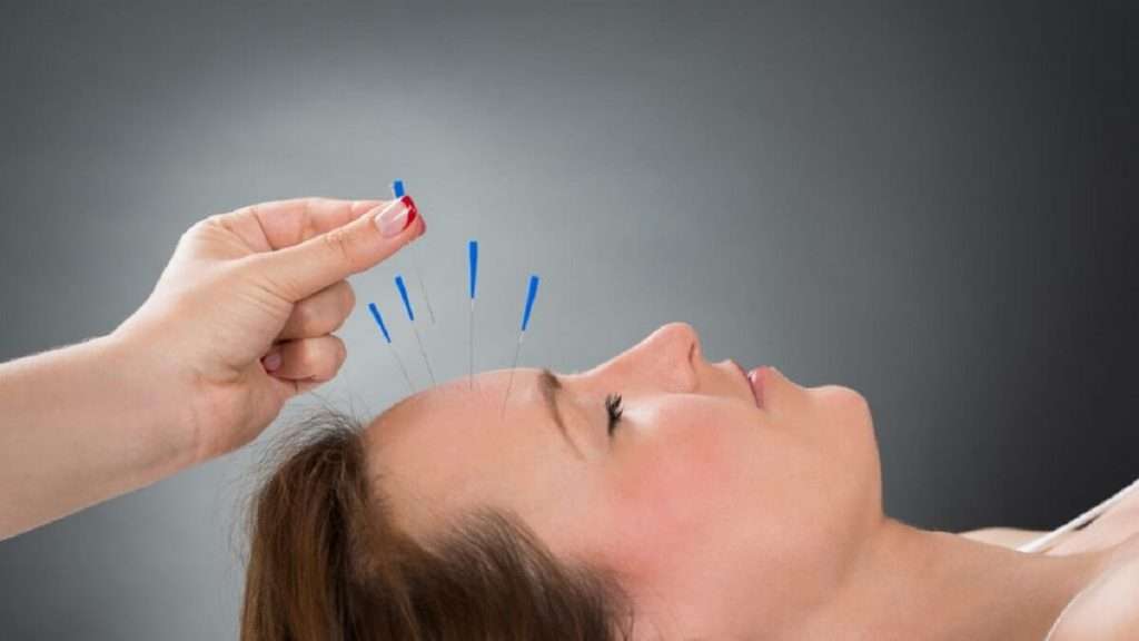 طب سوزنی یا اکوپانچر