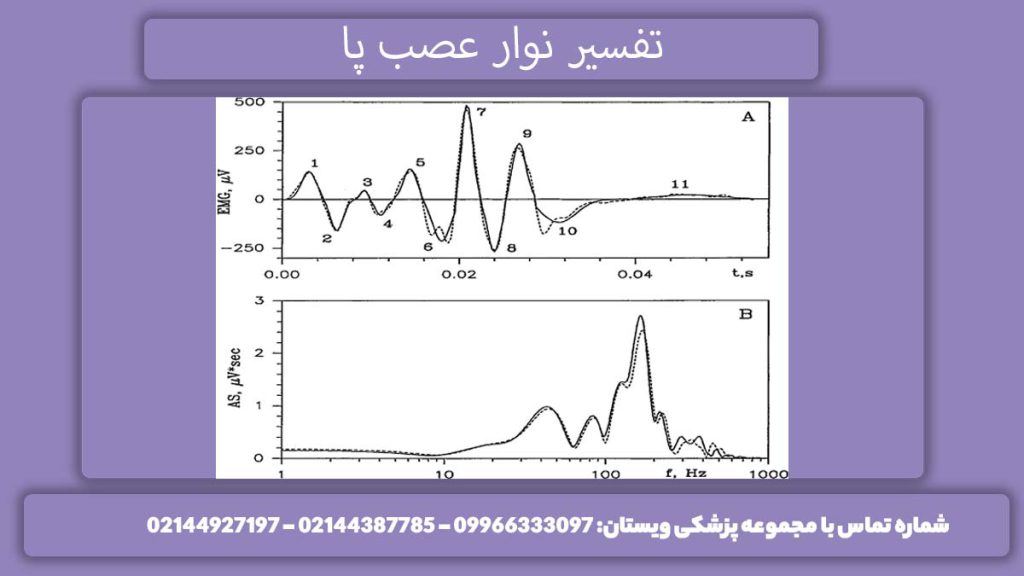 تفسیر الکترومیوگرافی ناحیه پا ارزیابی آزمایش هدایت عصبی
