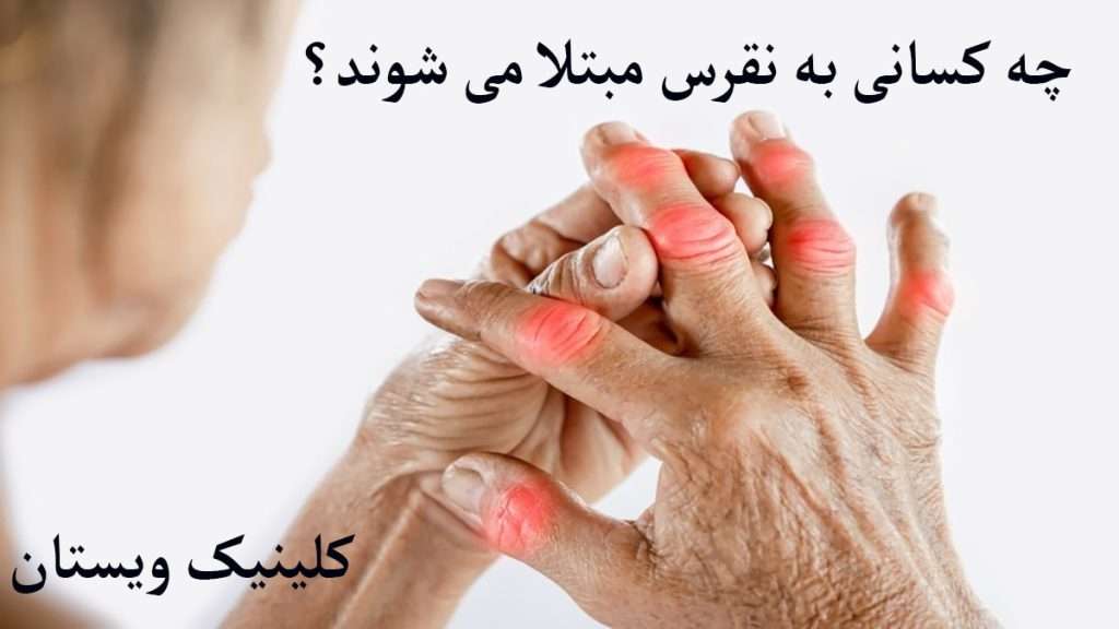 نقرس شخصی دارای نقرس در انگشتان دست است