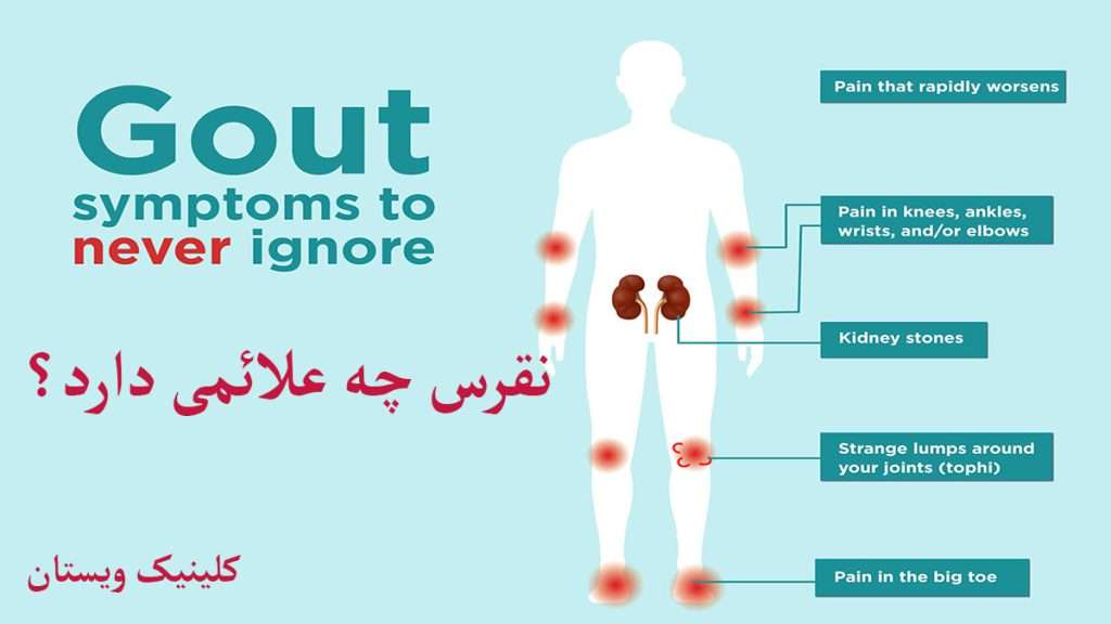 علائم نقرس علائم نقرس را نشان می دهد.