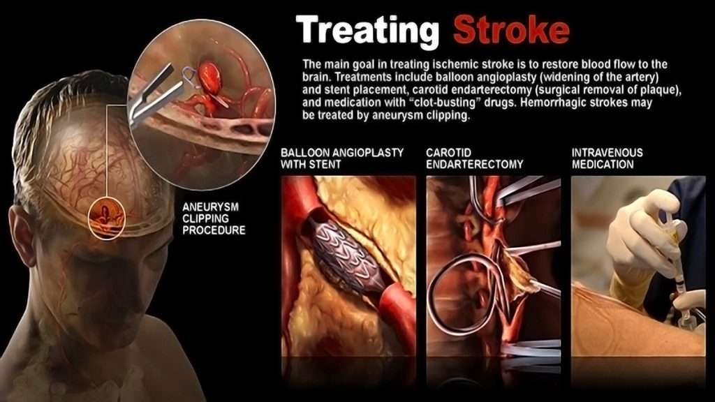 ممکن است نیاز به برنامههای تحت نظر پزشکی مانند فیزیوتراپی و توانبخشی ممکن است پس از سکته قلبی، انجام تستهای تصویربرداری مانند اکوکاردیوگرافی مورد نیاز باشد.
