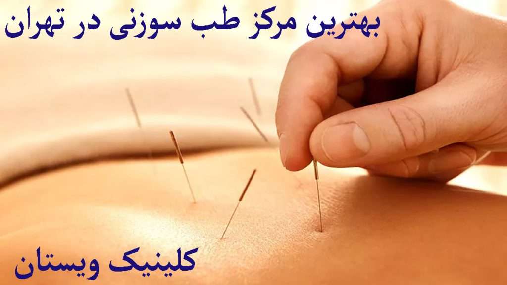 بهترین کلینیک طب سوزنی طب سوزنی برای کتف و کمر