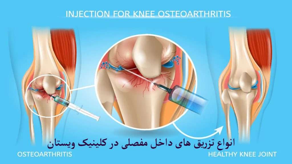 انواع تزریق داخل مفصل زانو تزریق داخل مفصل زانو