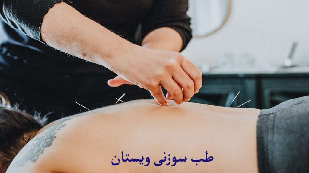 طب سوزنی طب سوزنی برای ناحیه کتف توسط متخصص انجام می شود