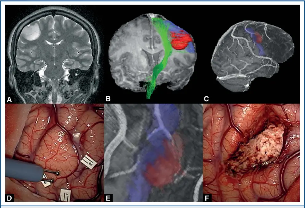 تومورهای خوش خیم یا بدخیم
