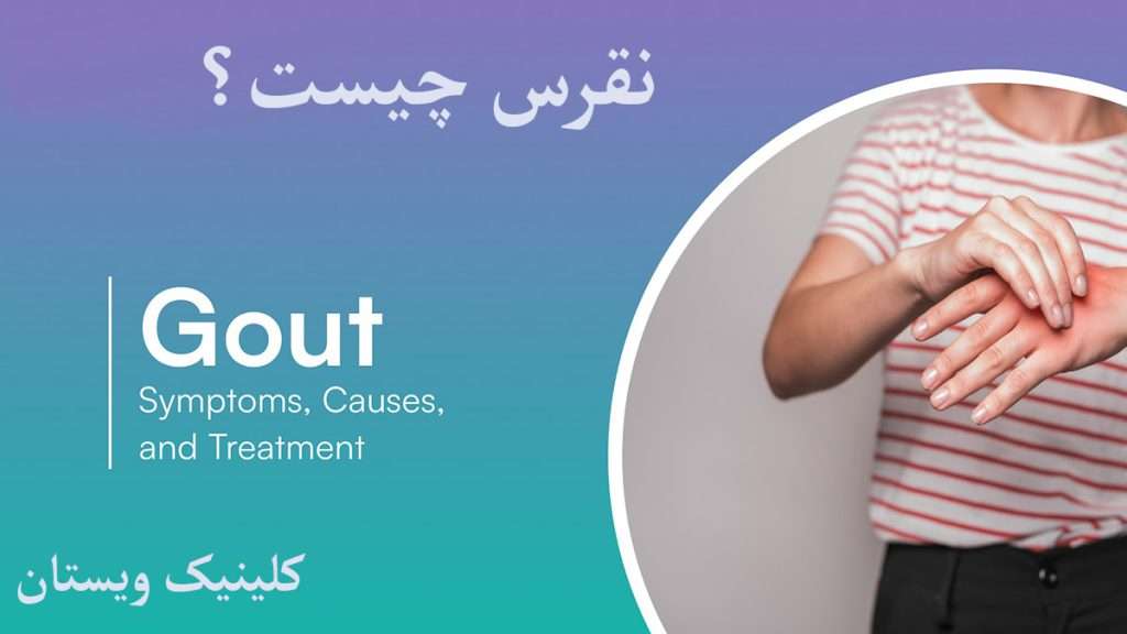 نقرس دست شخص دارای نقرس دست است-درمان نقرس