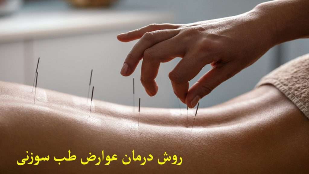 درمان عوارض طب سوزنی طب سوزنی برای کمر