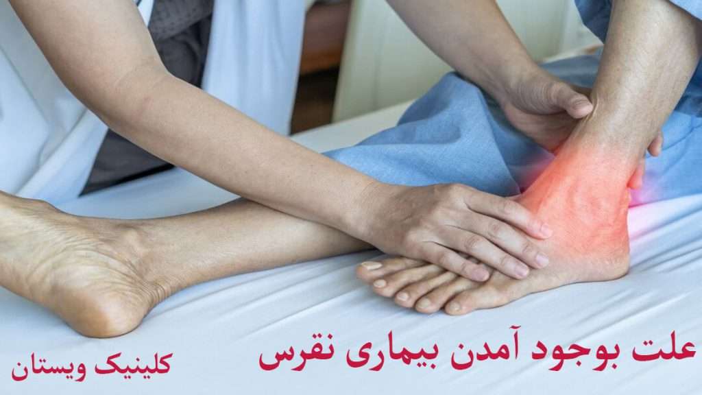 علت ننقرس چیست پزشک در حال معاینه شخص دارای نقرس است
