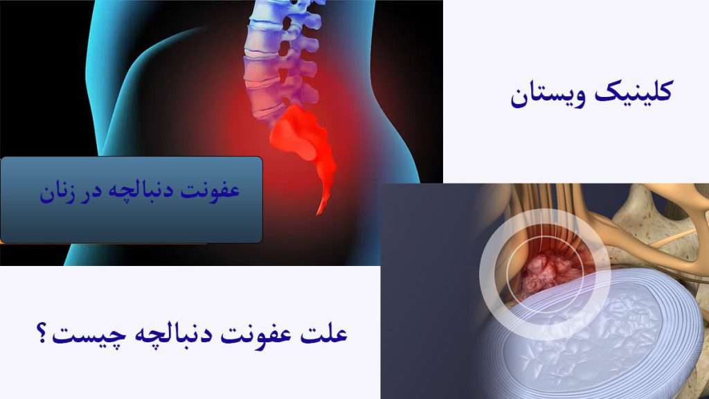 علت عفونت دنبالچه عفونت در ناحیه دنبالچه