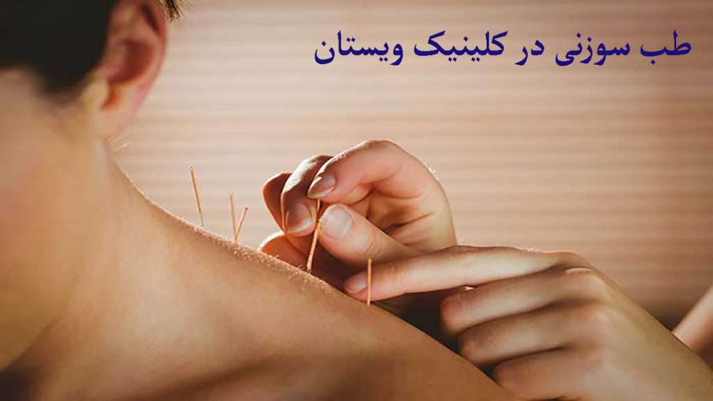 مدیریت طب سوزنی طب سوزنی گردن