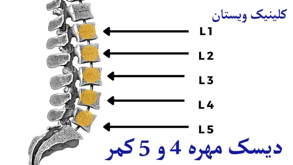 دیسک مهره 4 و 5 کمر مهره های ستون فقرات نمایش داده می شود