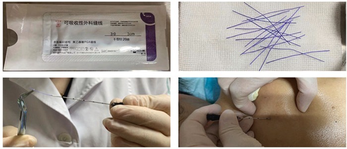 نخ لاغری طب سوزنی به کاهش اشتها و افزایش انرژی بدن کمک میکند. نخ لاغری طب سوزنی بهبود متابولیسم بدن را تسهیل میکند.