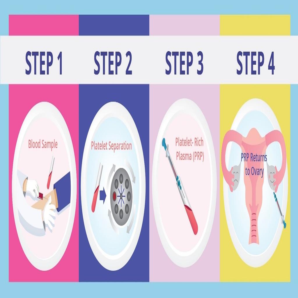افزایش باروری مراحل تزریق پی آر پی