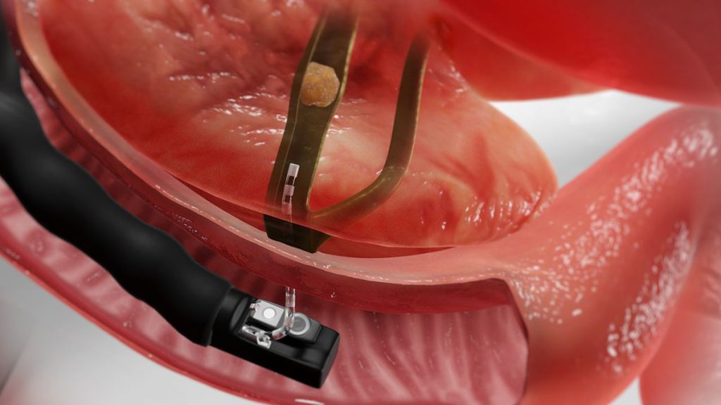 کلانژیوپانکراتوگرافی رتروگراد آندوسکوپی (ERCP) تمام اشعه ایکس را که دریافت