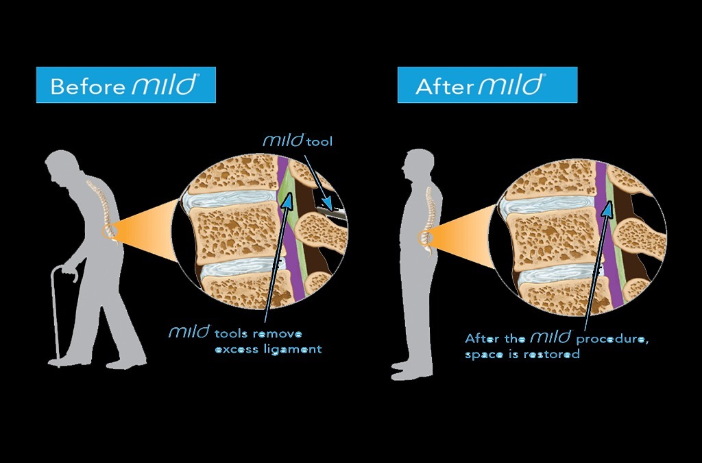 گودی کمر ممکن است به دلایل ژنتیکی نیز بوجود آید. استفاده از کمربندهای طبی در برخی مواقع میتواند موثر باشد.