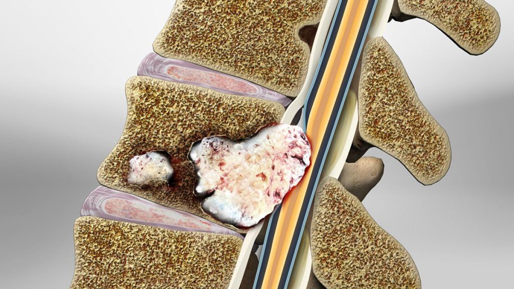 تصویربرداری رزونانس مغناطیسی (MRI) از مغز و ستون فقرات ممکن است مناطقی از دمیلیناسیون (ضایعات یا پلاک) را نشان دهد پاتوفیزیولوژی و مکانیسم های ایجاد خستگی ام اس به خوبی شناخته نشده است