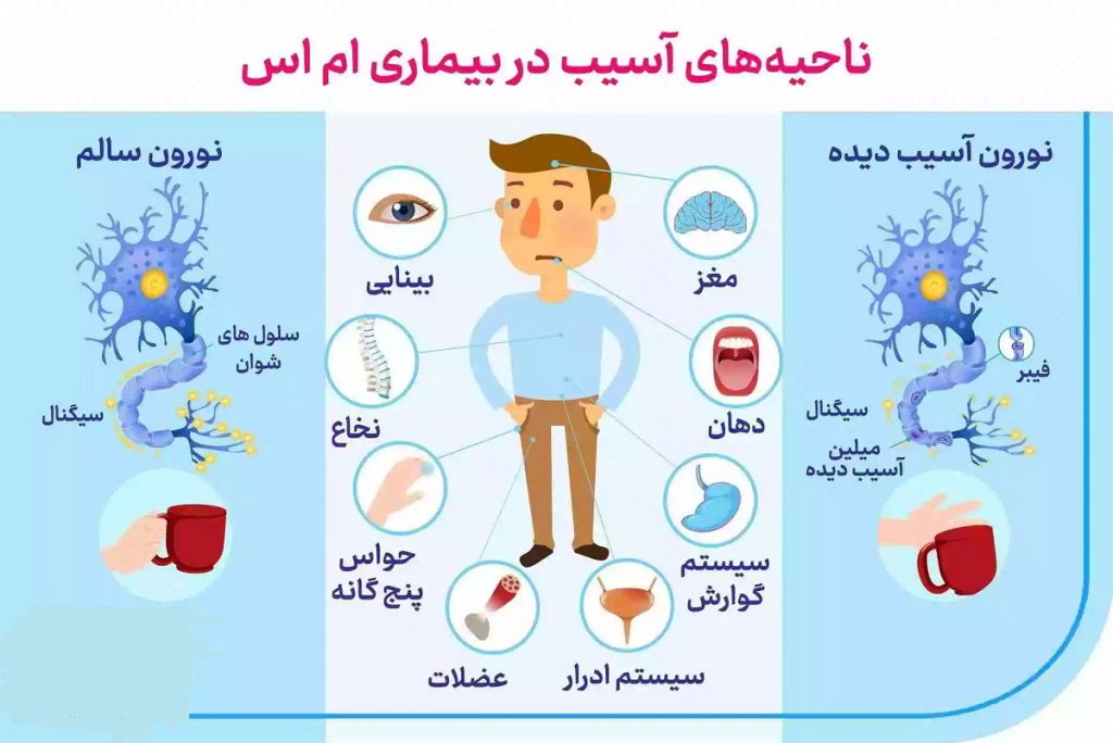 ناحیه های آسیب دیده توسط ام اس ناحیه های آسیب دیده توسط ام اس