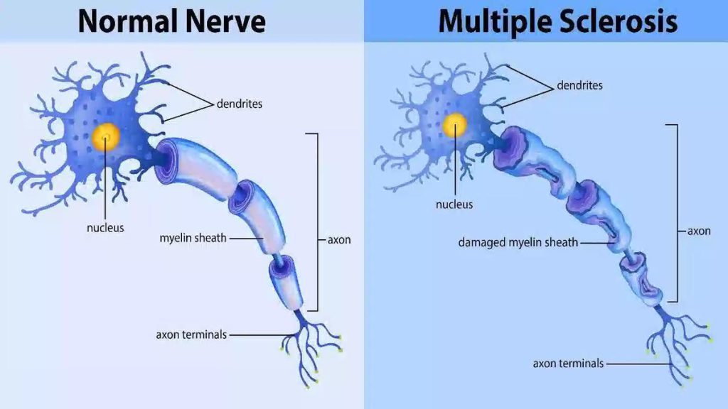 اوکرلیزوماب (Ocrevus) زیتاکس (Rituximab)