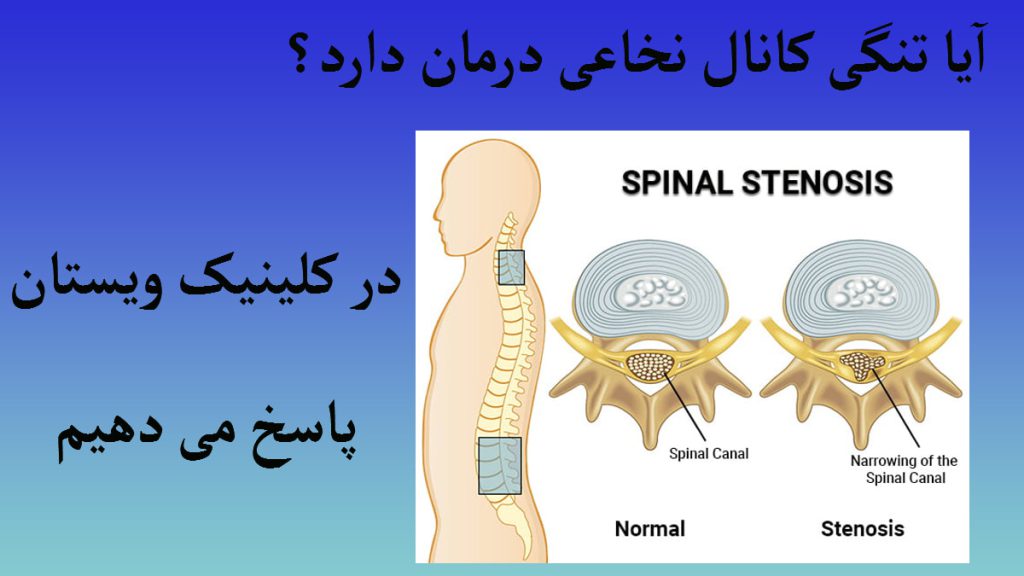 درمان تنگی کانال نخاعی دو مهره از ستون فقرات و نخاع و ستون فقرات یک شخص