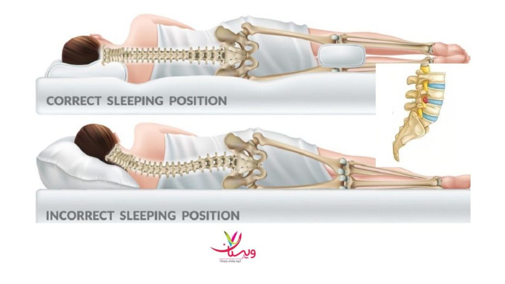 نحوه خوابیدن درست و غلط فرد مبتلا به دیسک بهترین پوزیشن خواب برای دیسک کمر