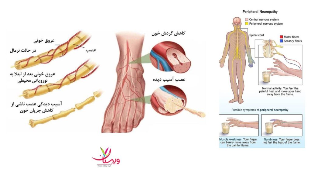 کپسول نوروتک خارجی بیماری نوروپاتی چیست