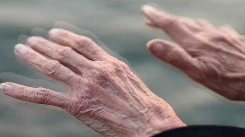 سفتی عضلات اختلال عصبی پیشرونده