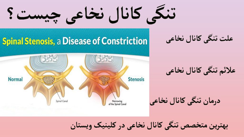 مهره ستون فقرات و نخاع داخل آن و مهره ای دیگر که دچار تنگی کانال نخاعی شده است