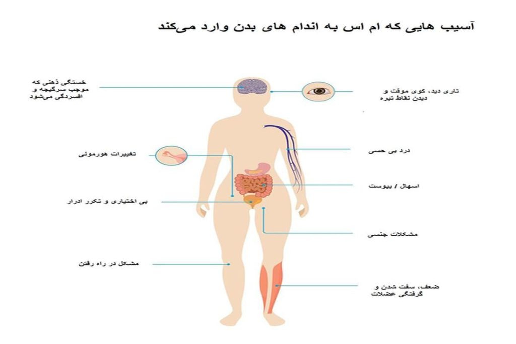 تحقیق تخصصی MS مولتیپل اسکلروزیس