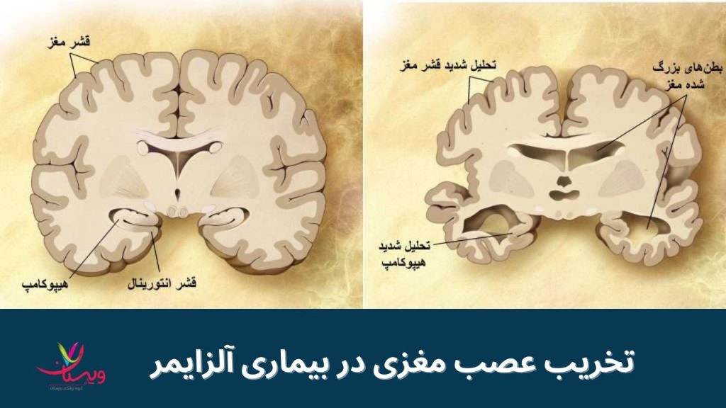 مغز بیماری آلزایمری سرعت پیشرفت آلزایمر