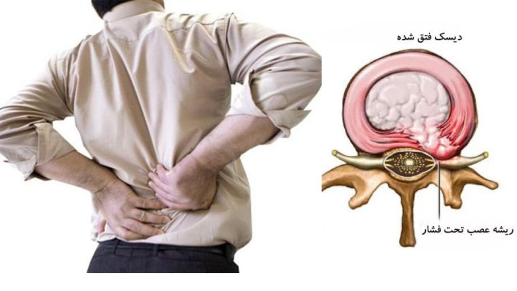 فرد مبتلا به دیسک کمر طریقه-مصرف-نوروتک-در-فرد-مبتلا-به-دیسک-کمر