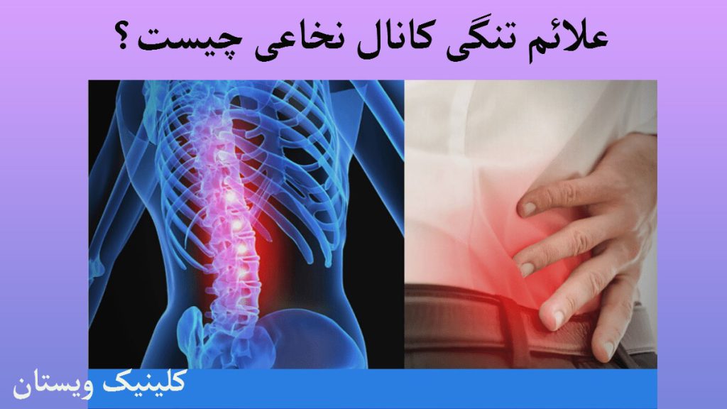 علائم تنگی کانال نخاعی یک شخص که دستش را به کمرش گرفته- یک تصویر دیجیتالی از ستون فقرات