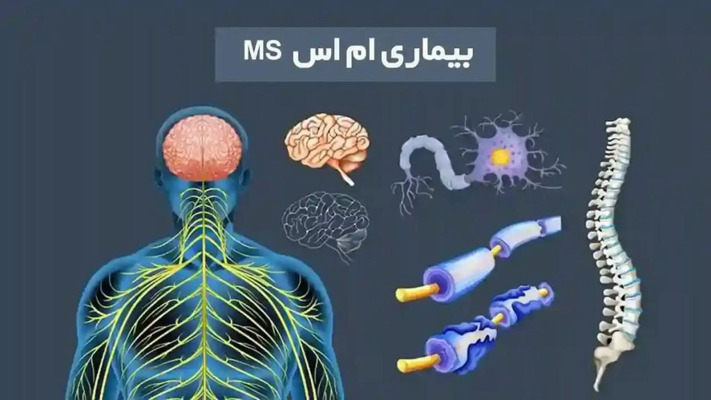 درمان مولتیپل اسکلروزیس (MS) مدیریت زندگی با MS