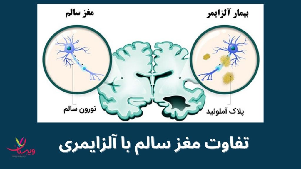 دلایل مرگ بیماران آلزایمری اخرین مرحله الزایمر