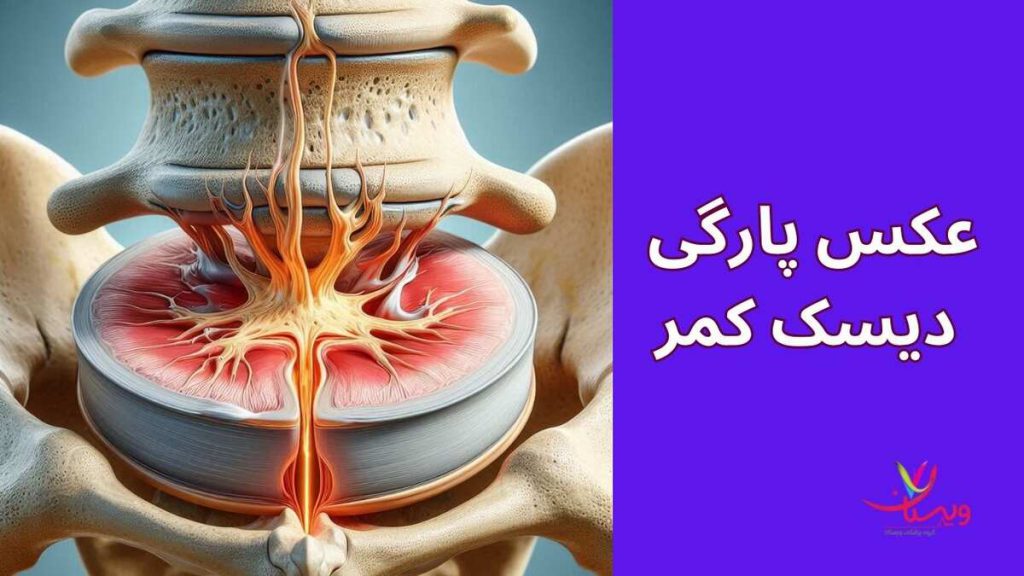 پاره شدن دیسک کمر عکس پارگی دیسک کمر